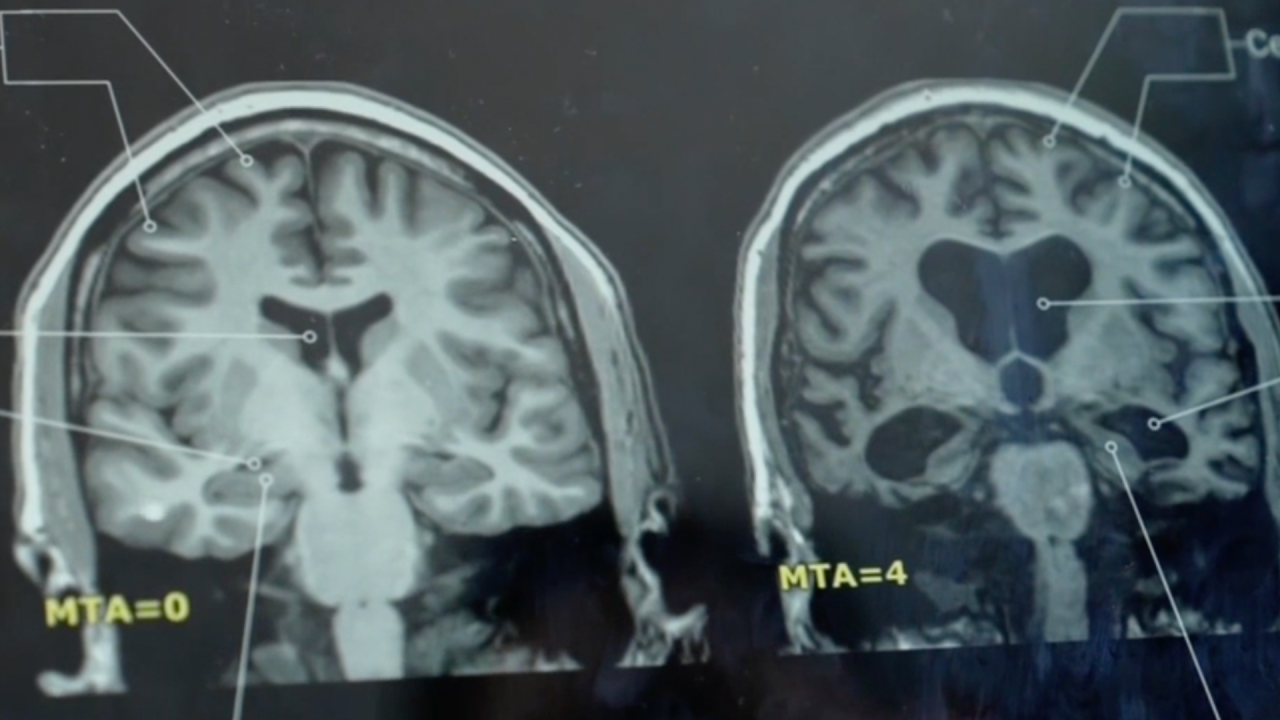 Brain